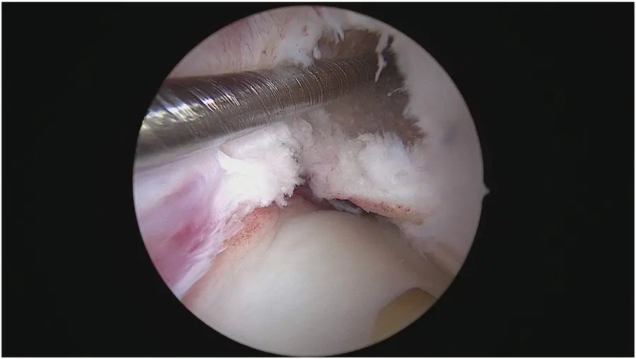 Arthroskopische Aufnahme während einer Kreuzbandoperation