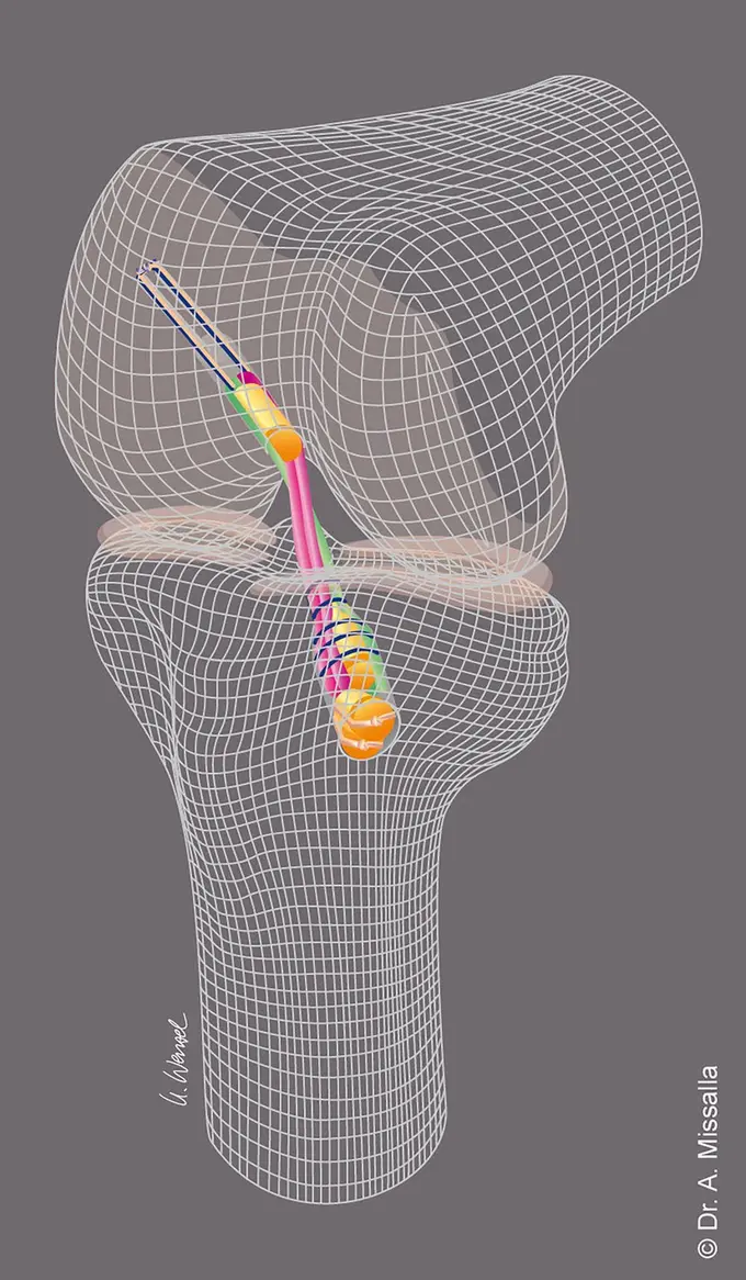 3D-Darstellung eines Kniegelenks mit Kreuzbandplastik in Press-Fit-Hybrid-Technik: Sehnentransplantat mit körpereigenen Knochenzylindern verankert (© Dr. A. Missalla)